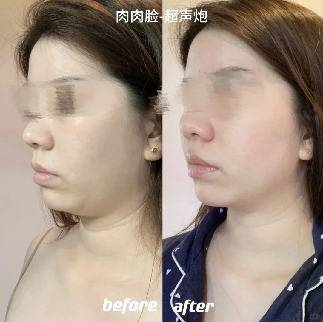 肉肉和瘦瘦 抗衰思路大不同
