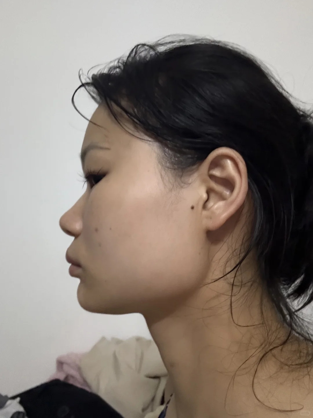 瘦脸 肉毒素