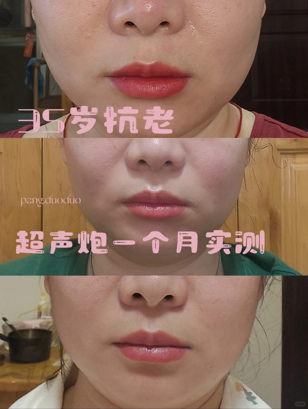 35岁纯素人做超声炮一个月体验
