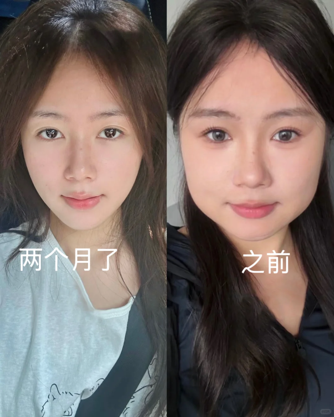瘦脸+下颌缘两个月，真的有点离不开了