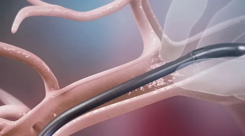 “肺栓塞+新技术+巨大市场”,这款创新医疗器械值得关注!!