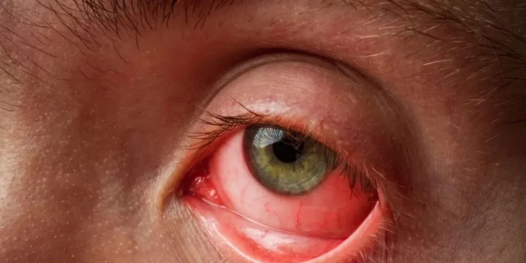 门急诊快速测红眼症,大有市场!