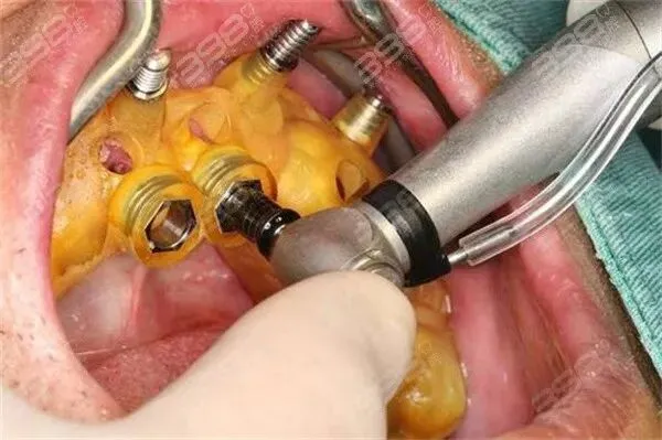 韩国爱臻植体真能用20年?是营销还是实力?看爱臻植体优缺点就知道