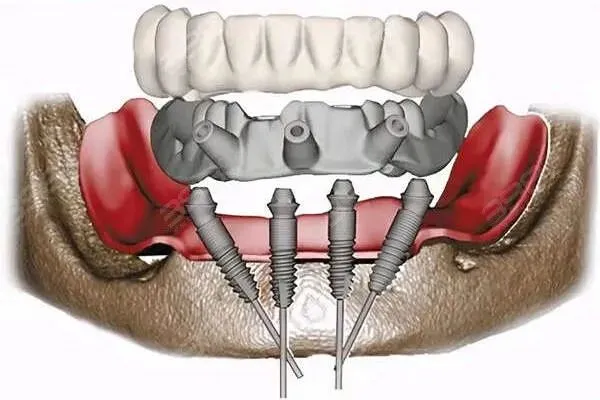 韩国爱臻植体真能用20年?是营销还是实力?看爱臻植体优缺点就知道