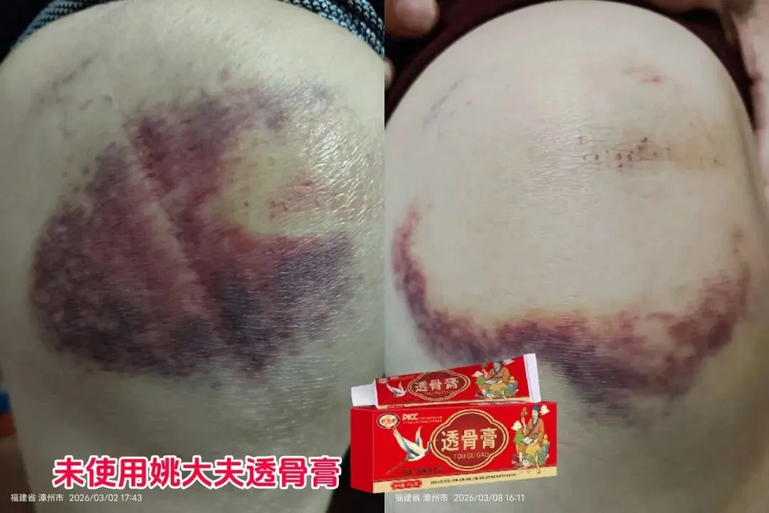 透骨膏疼痛市场各种反馈