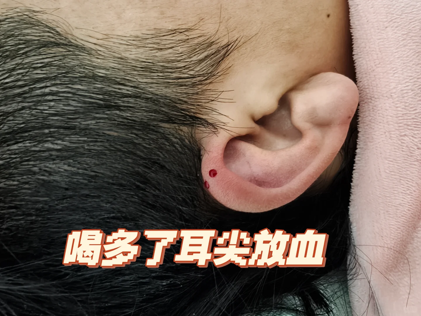 针灸实践-白酒喝多额头痛