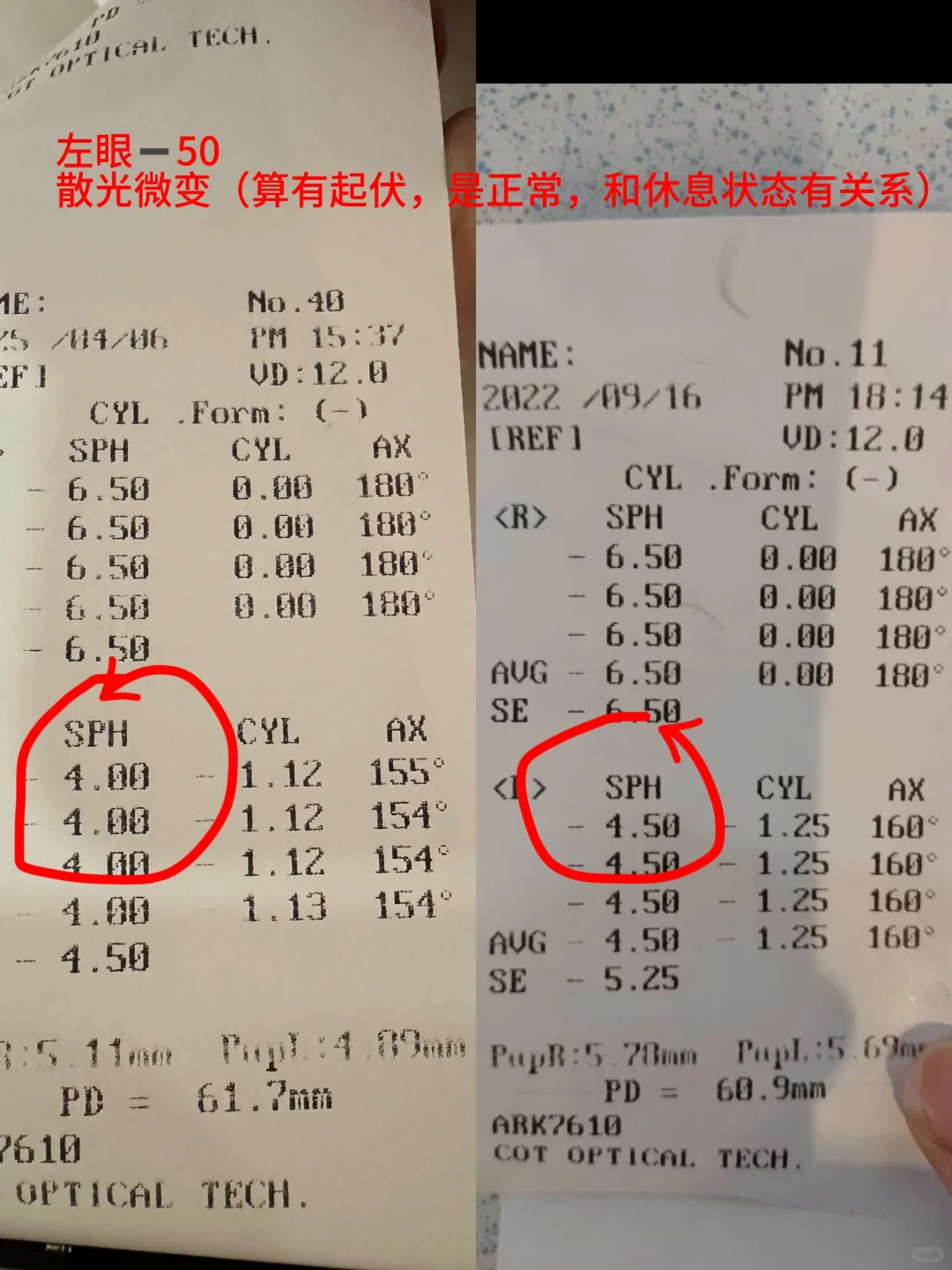 本人亲测，近视度数就是可降的（左眼-50°）