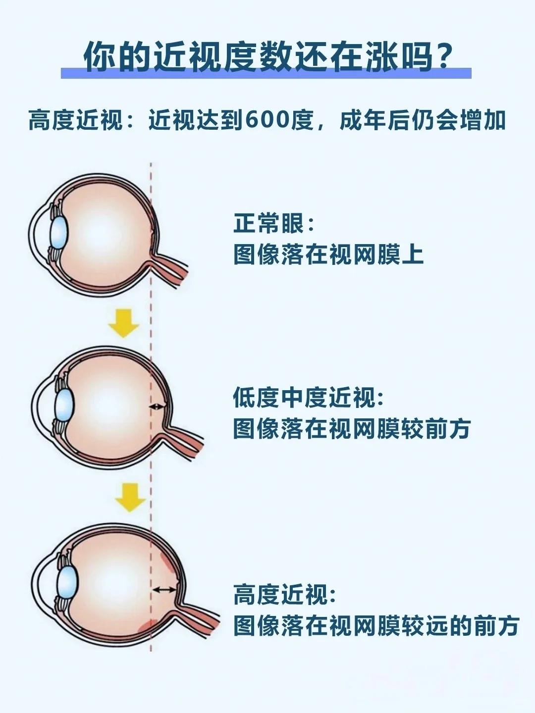 近视度数什么时候才会稳定❓??