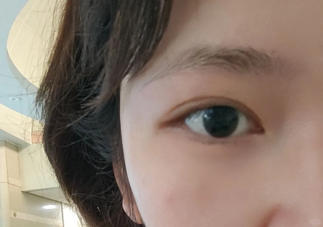 散瞳后度数低了两百多度