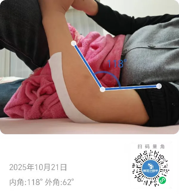 肘关节康复十一天，这个度数有变化吗