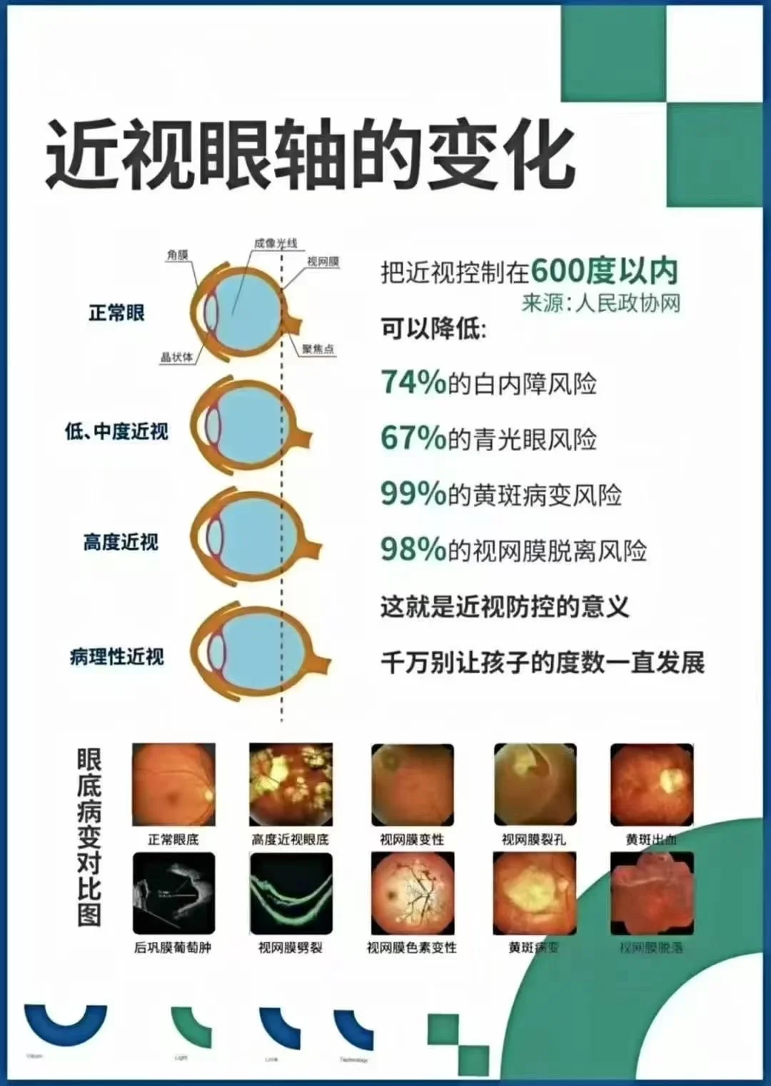 今日分享 近视防控的意义在于降低眼底病变