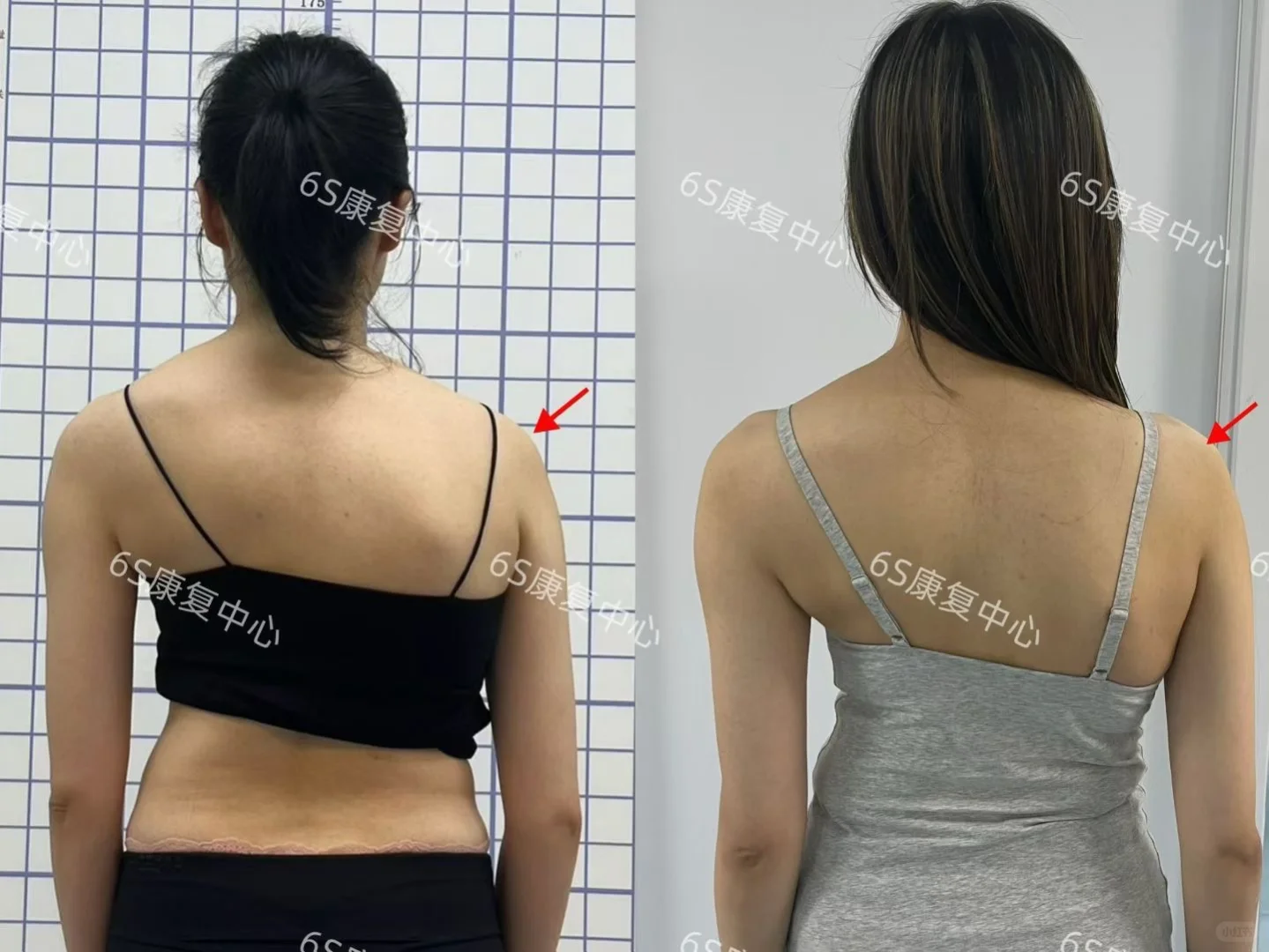 成人脊柱大度数侧弯变好