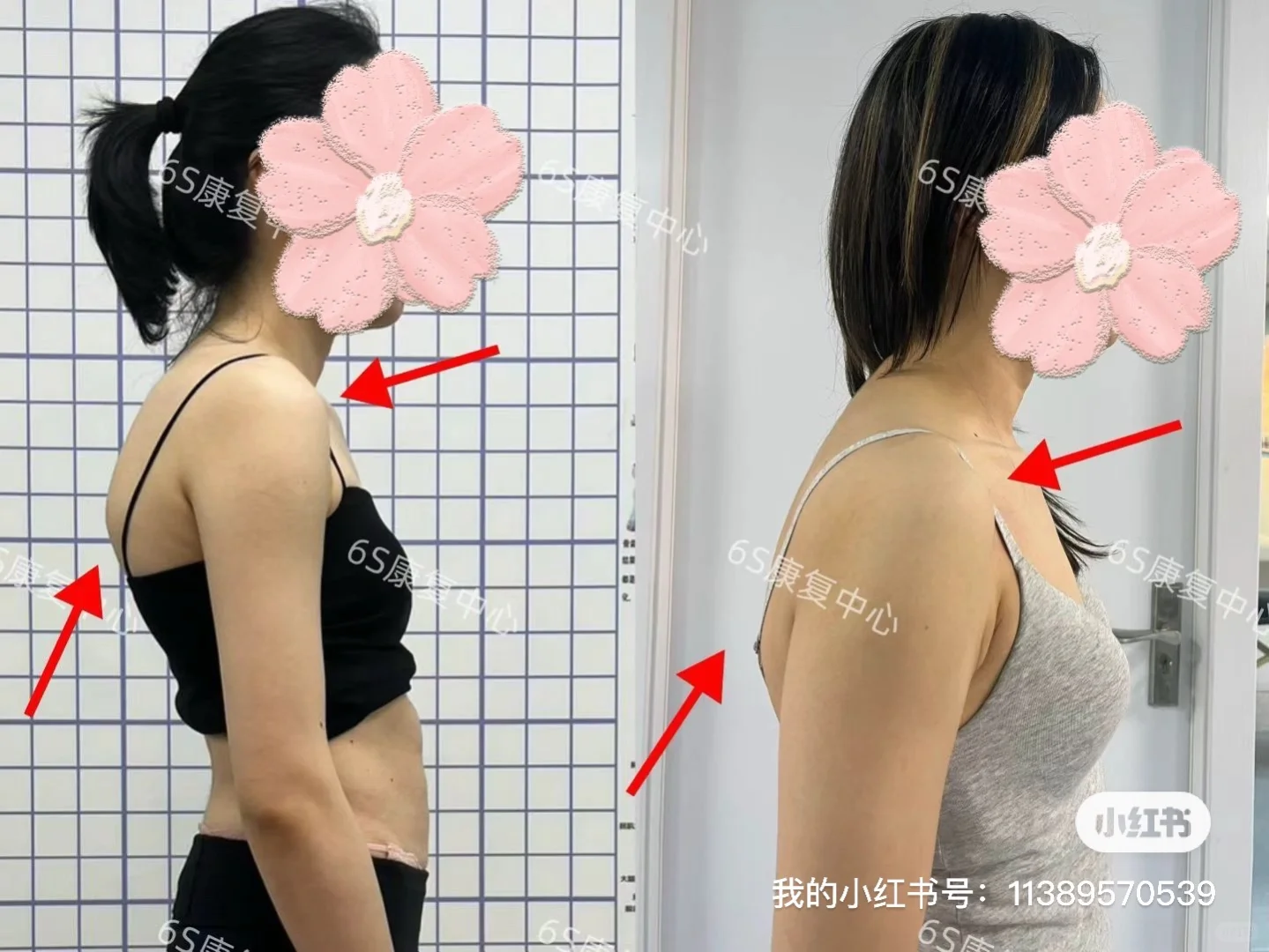 成人脊柱大度数侧弯变好