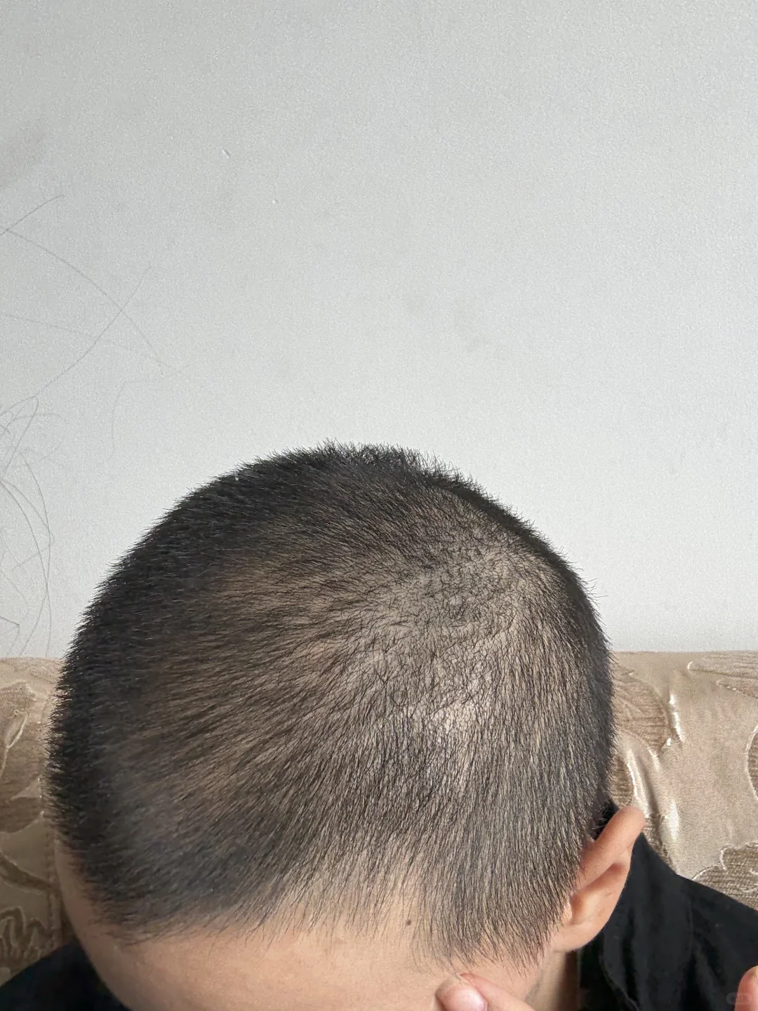 第二次光头蓄发第23天