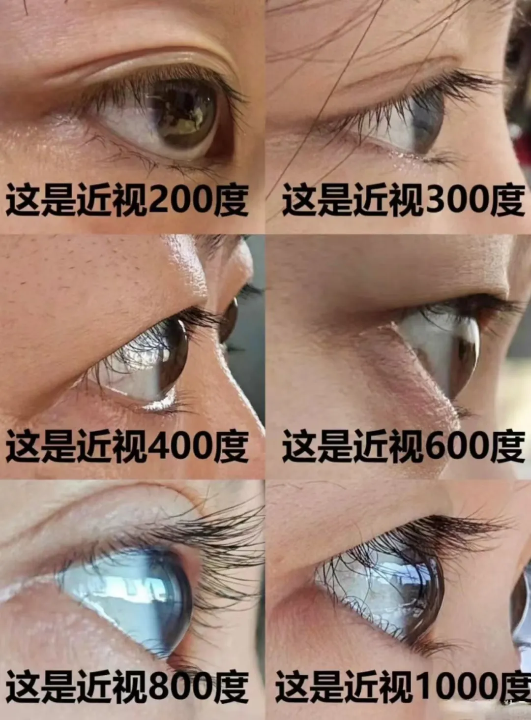 涨度数除了镜片的厚度，还有眼球的变化哦