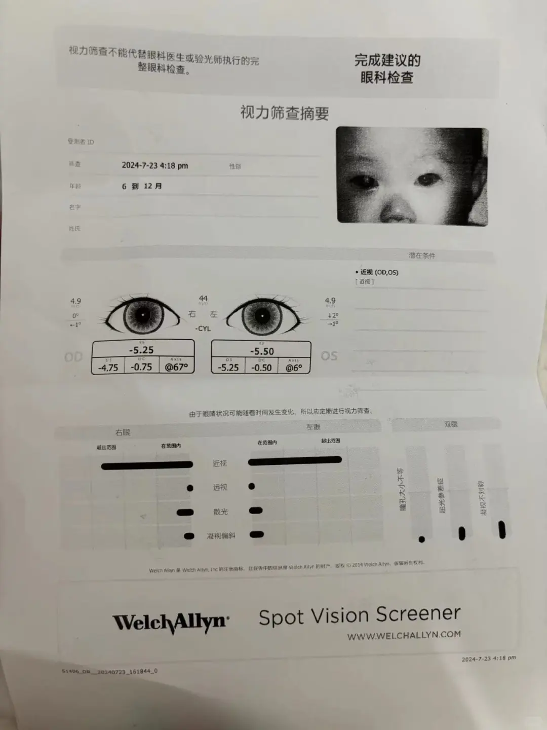 6个月儿保体检，近视400多度，怎么回事？