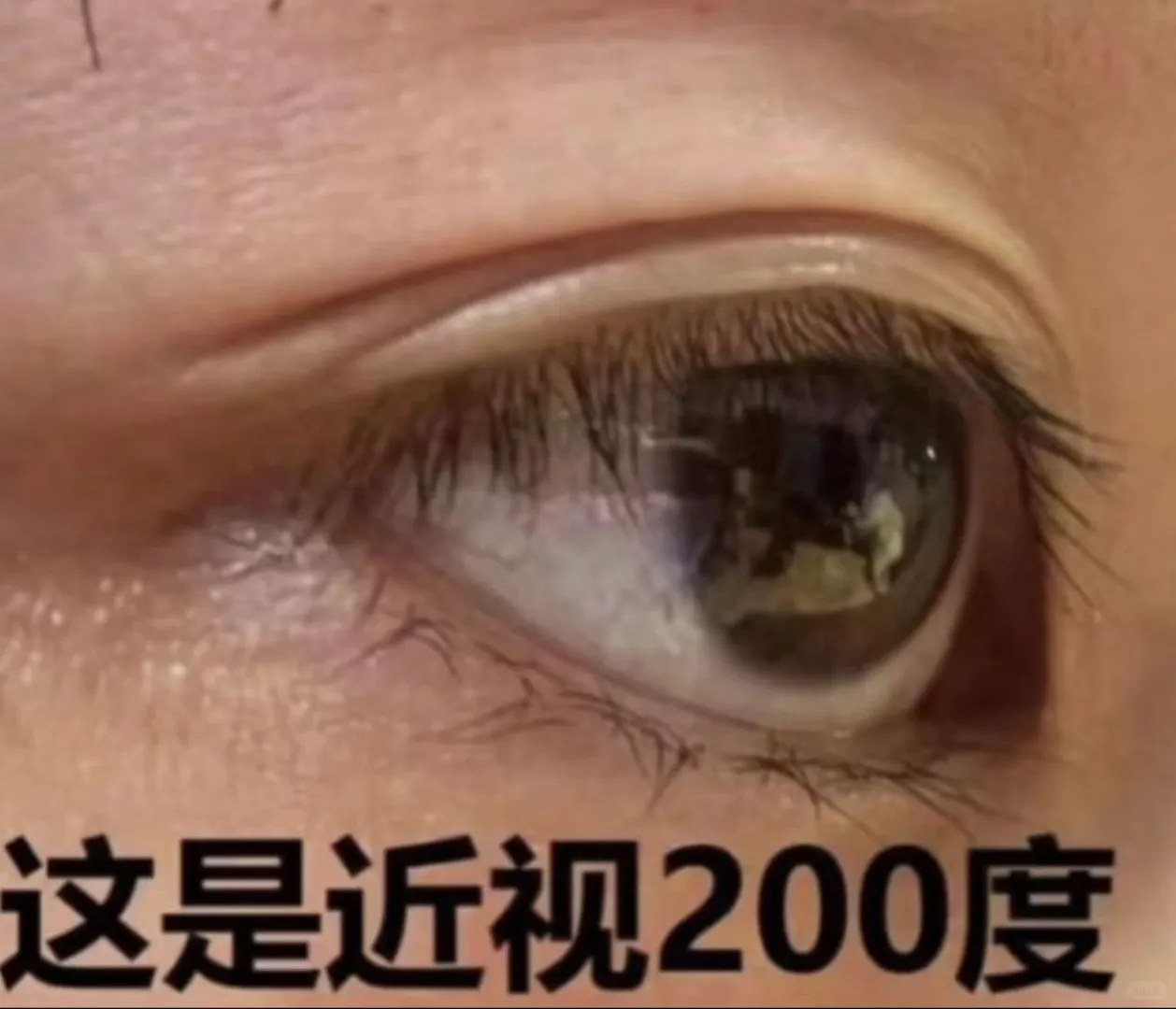 涨度数除了镜片的厚度，还有眼球的变化哦