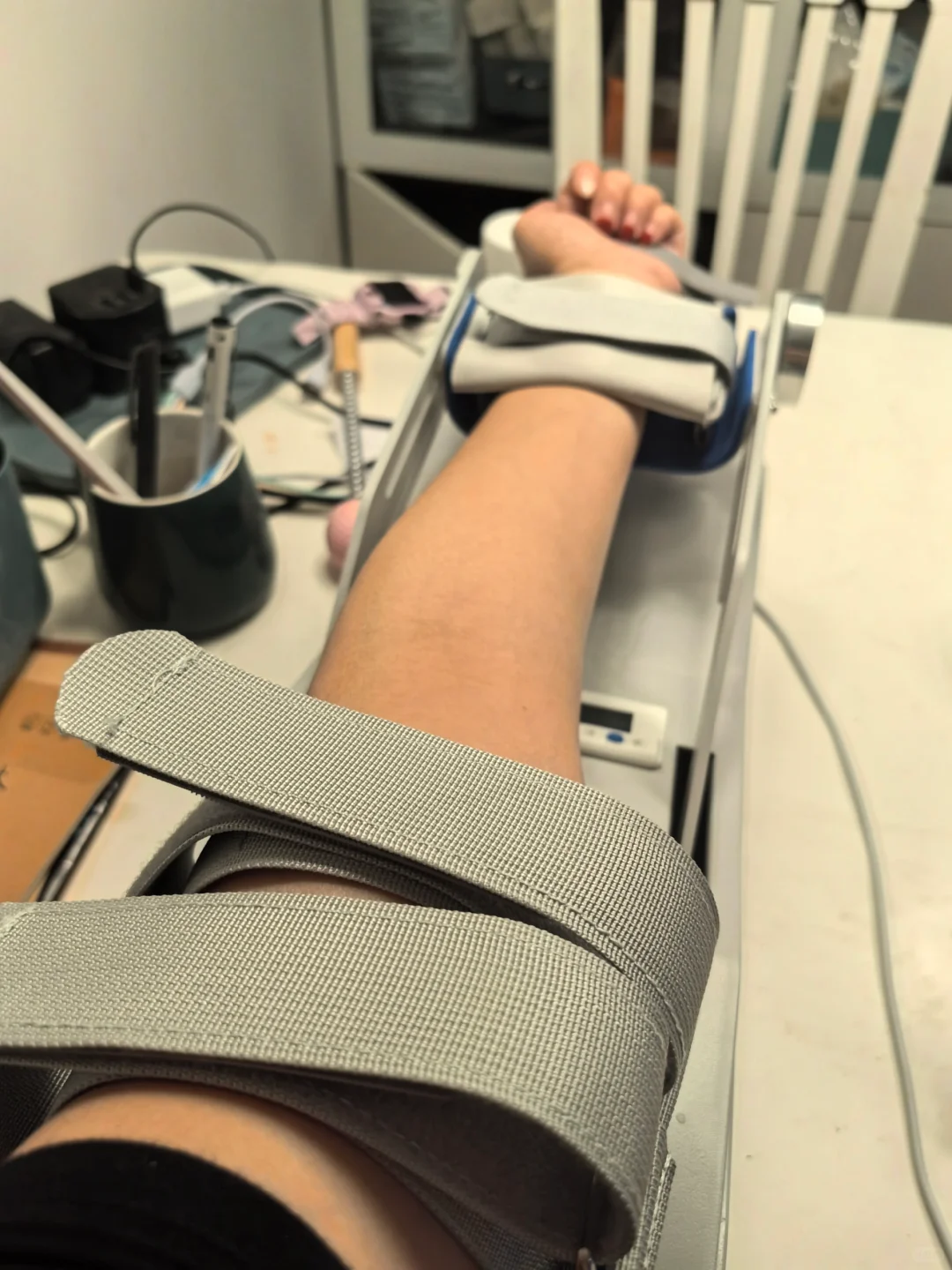 尺骨鹰嘴骨折 康复第二天