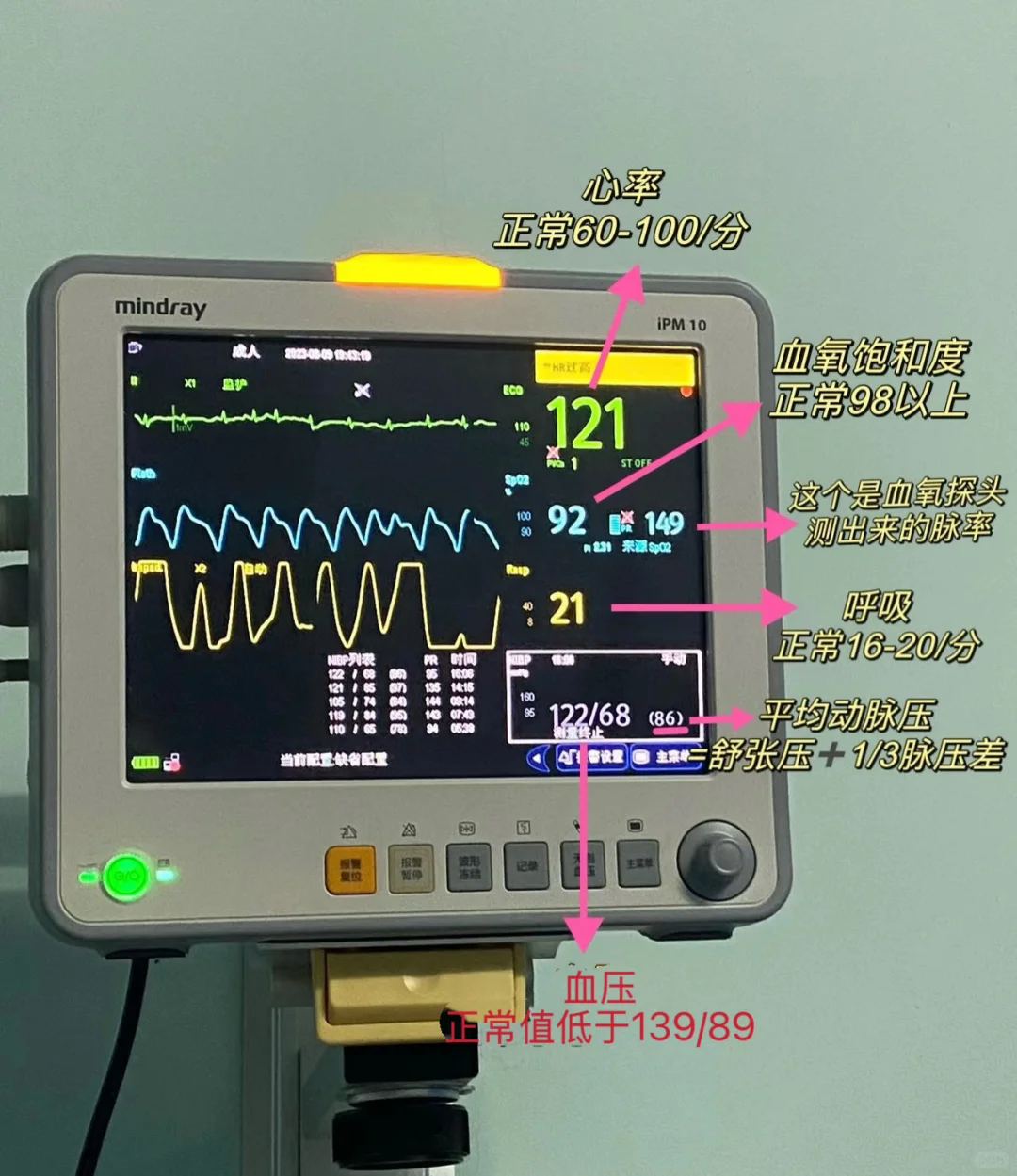 麻醉护士上线！天天用心电监护你掌握了多少