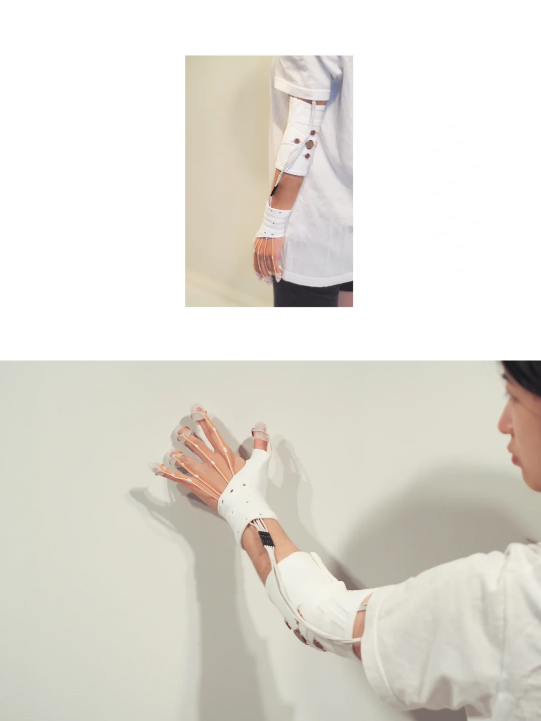 交互设计｜为无痛患者设计的可穿戴康复装置