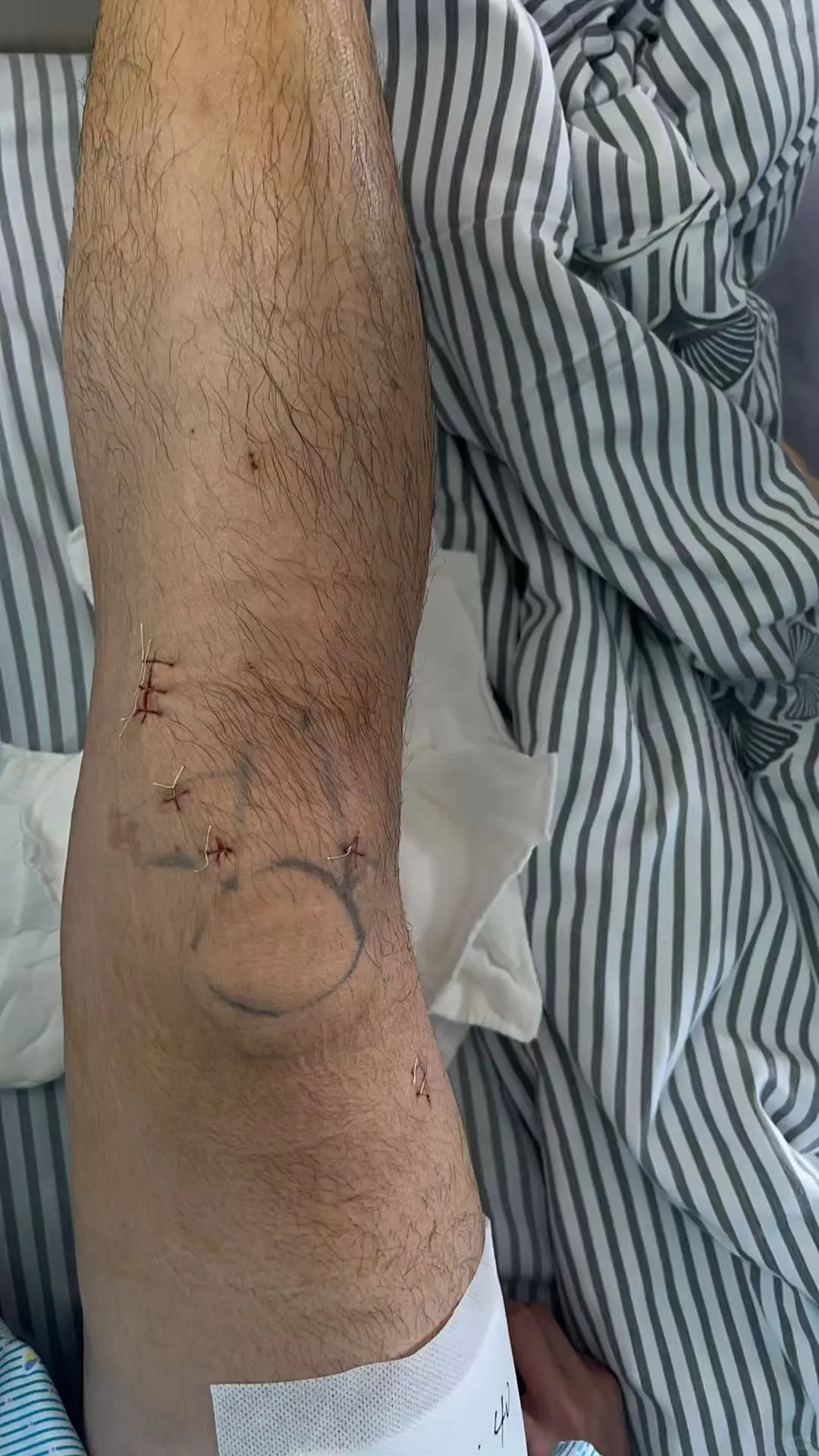 南京ACL重建手术 人工韧带