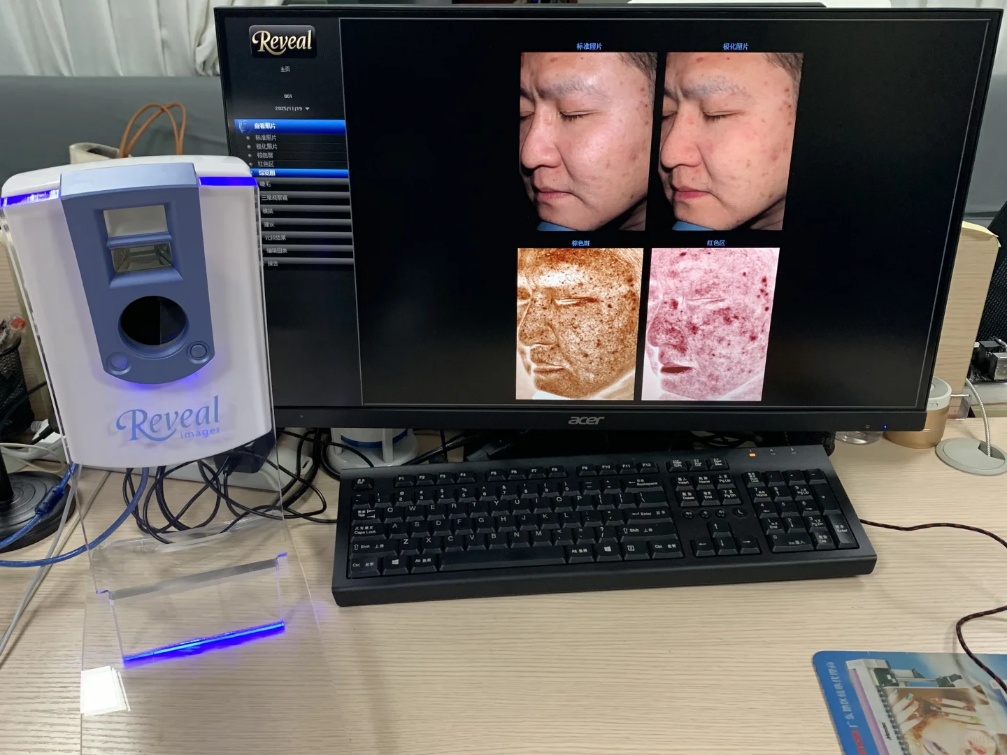 reveal皮肤检测仪