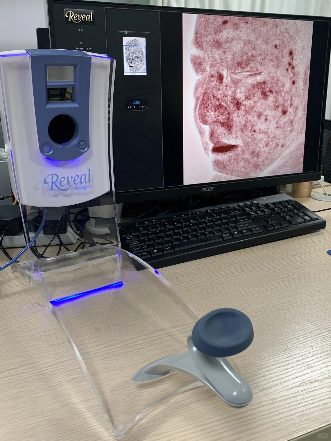 reveal皮肤检测仪