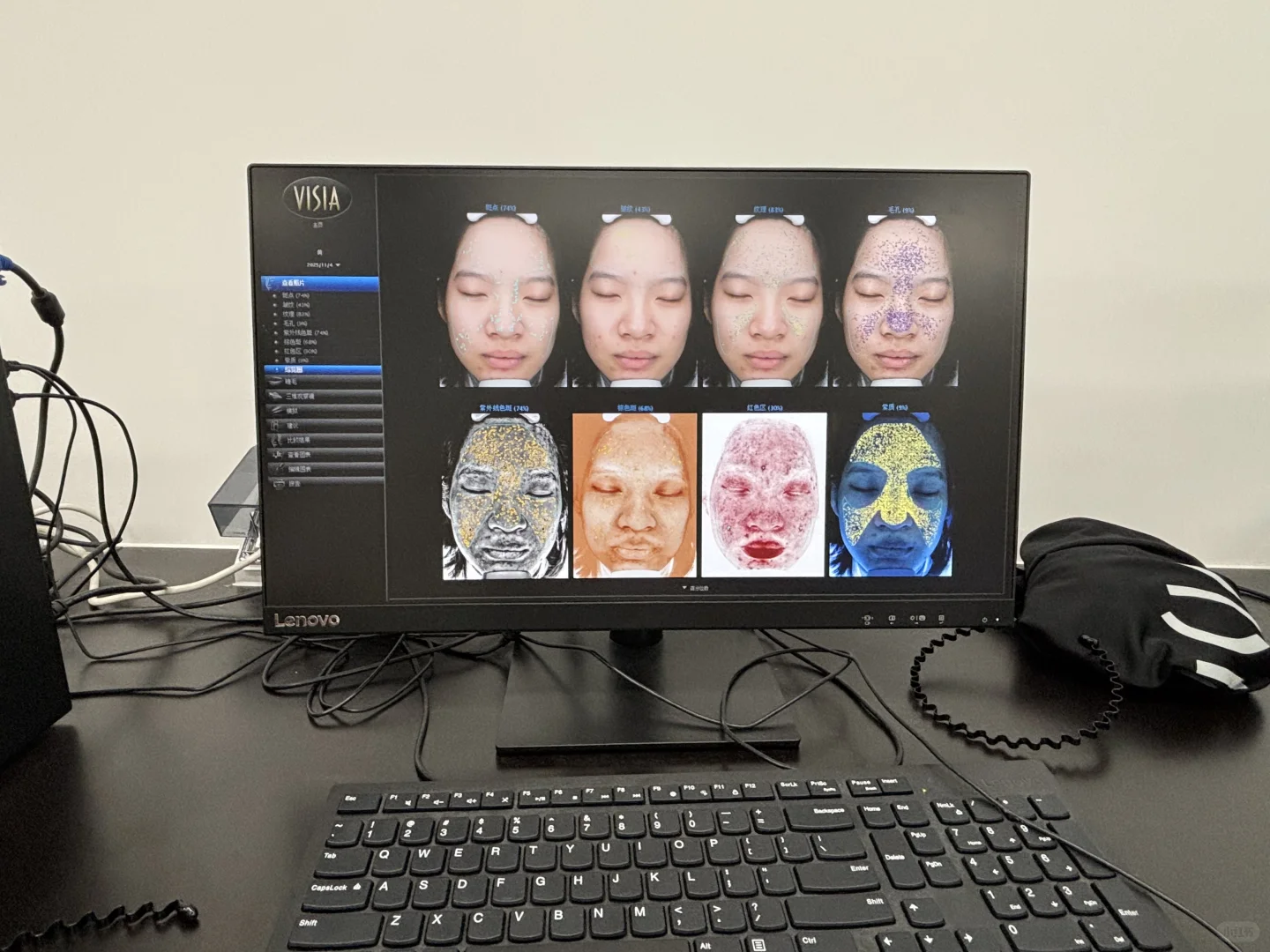 谁的学校还能免费做VISIA啊