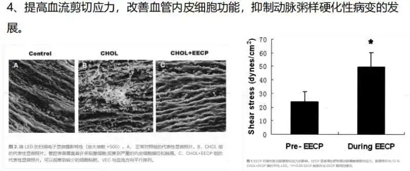 无创“生命加速器”EECP，了解一下？
