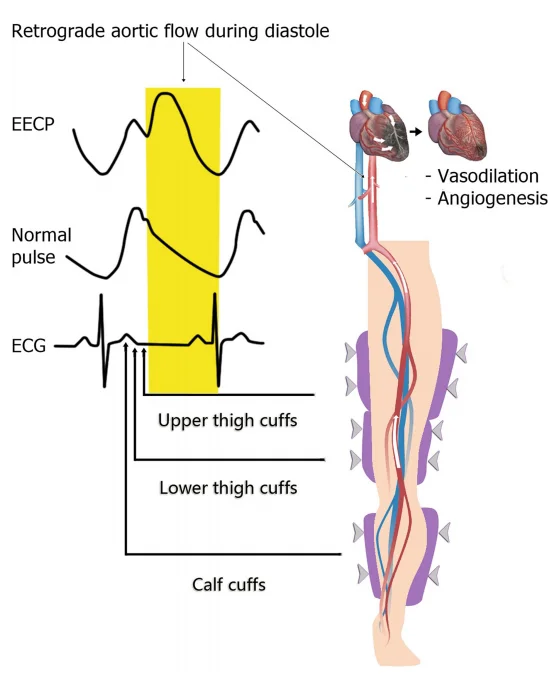 无创“生命加速器”EECP，了解一下？