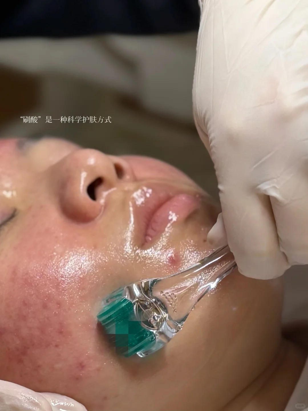 水杨酸翻土式疏通，科学周期护理=细腻肌