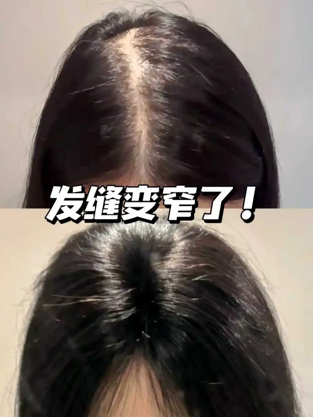 逆袭发量暴发户只需要选对防脱洗发水！！