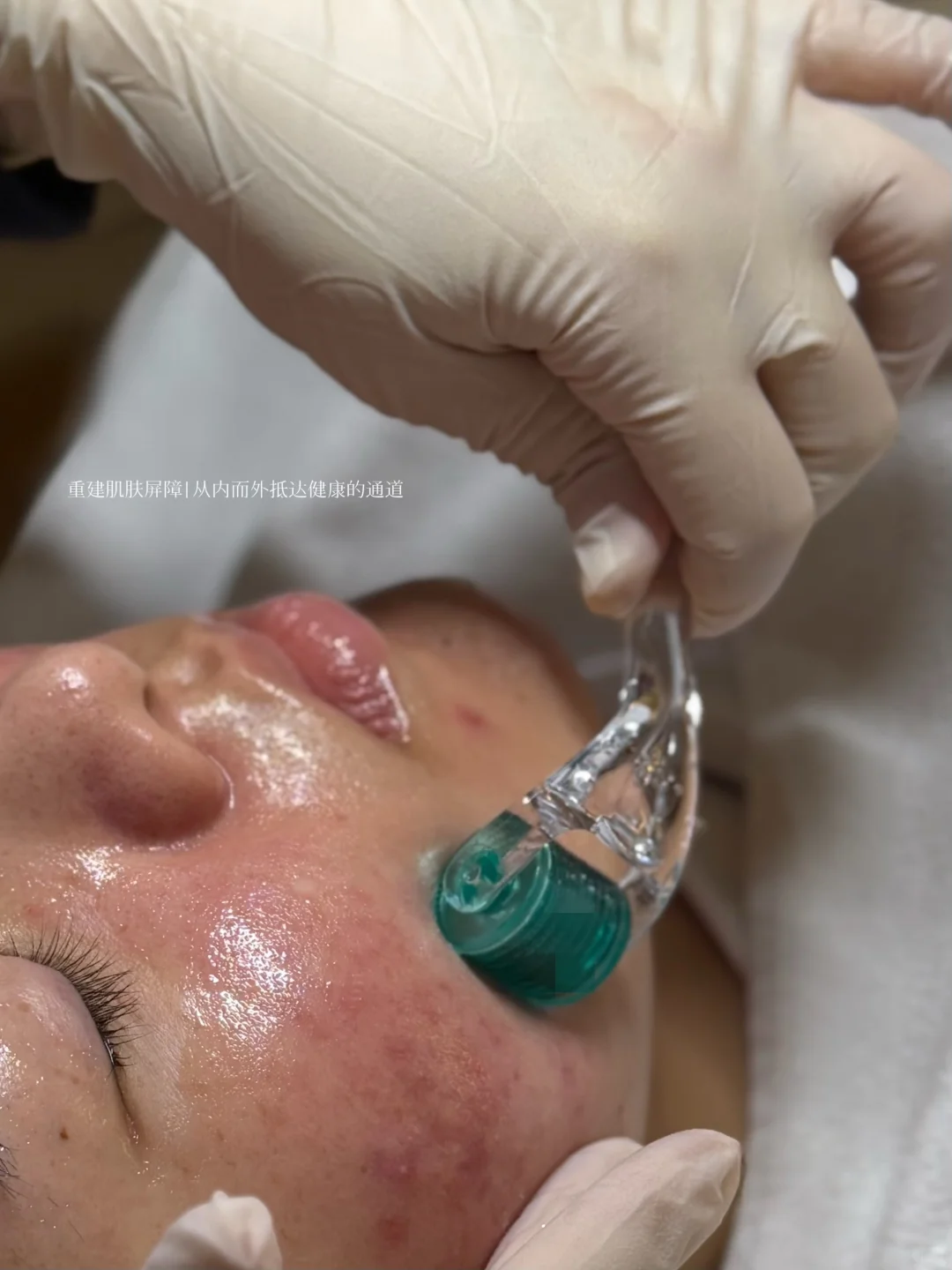 水杨酸翻土式疏通，科学周期护理=细腻肌