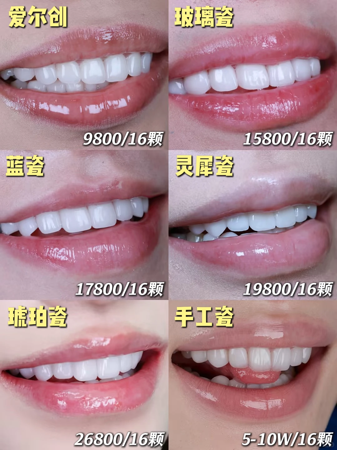 牙贴面|一篇看懂不同价位贴面优缺点