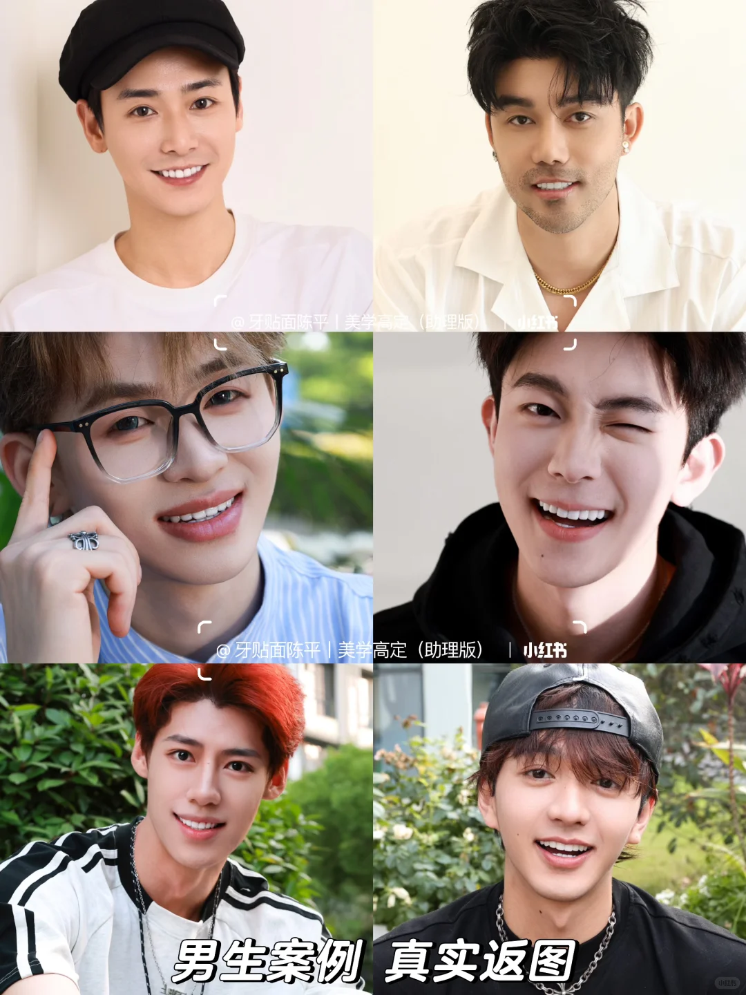 牙贴面|一篇看懂不同价位贴面优缺点