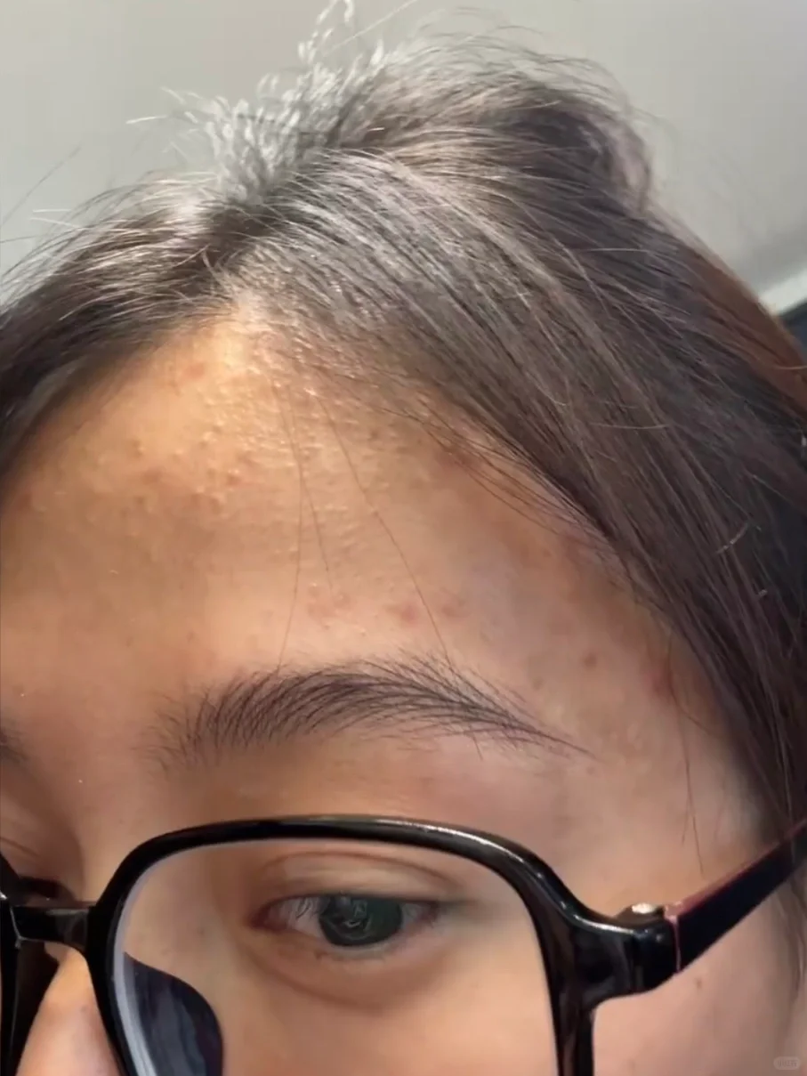 徐州女生纹眉第6天……