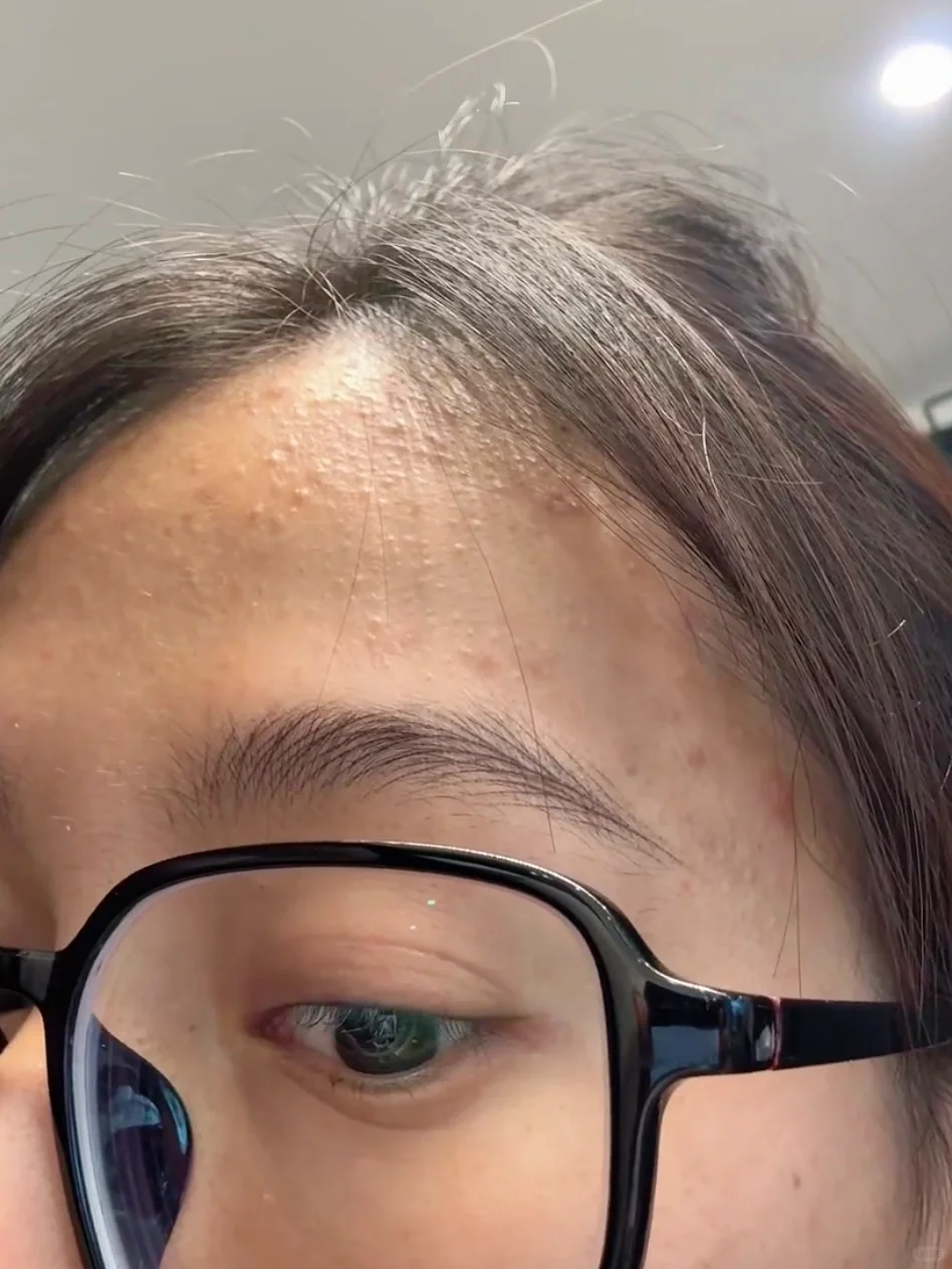 徐州女生纹眉第6天……