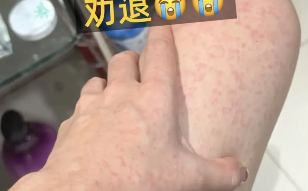 广州已回，已中招。。劝退警告❗️❗️