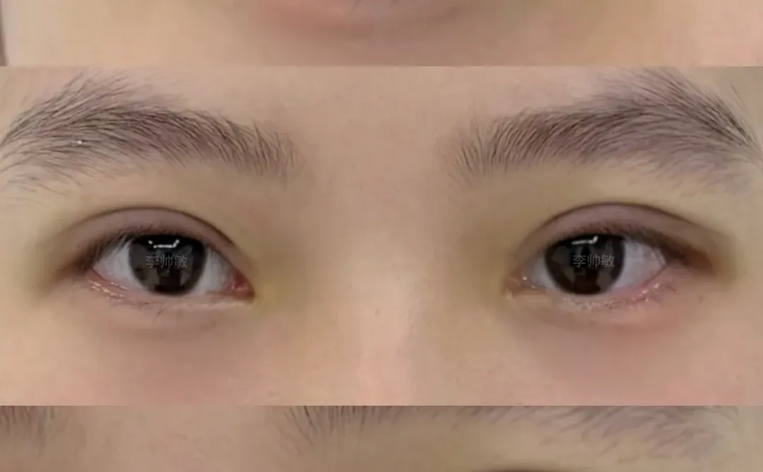 广州双眼皮｜肿眼泡即刻分享