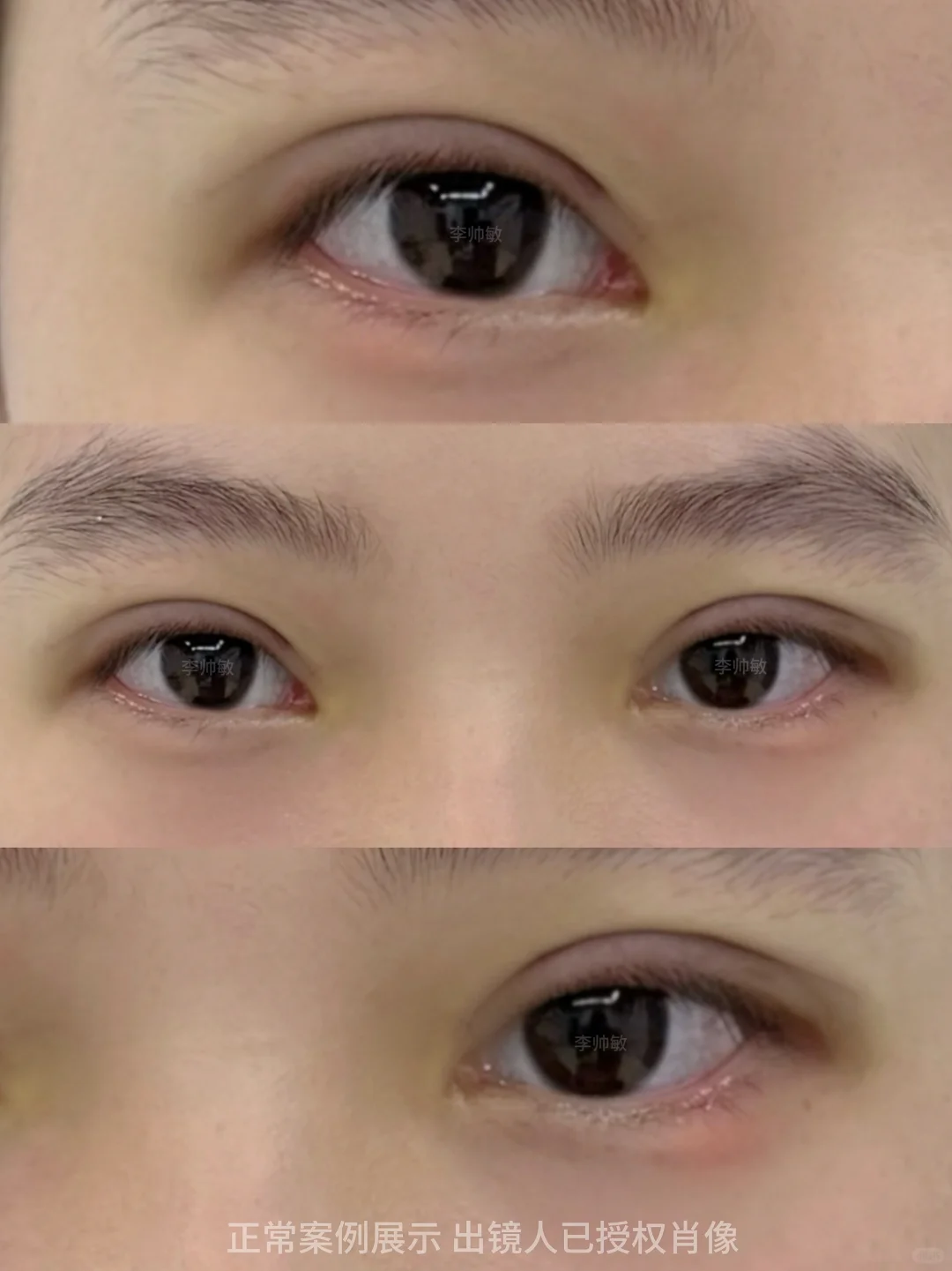 广州双眼皮｜肿眼泡即刻分享