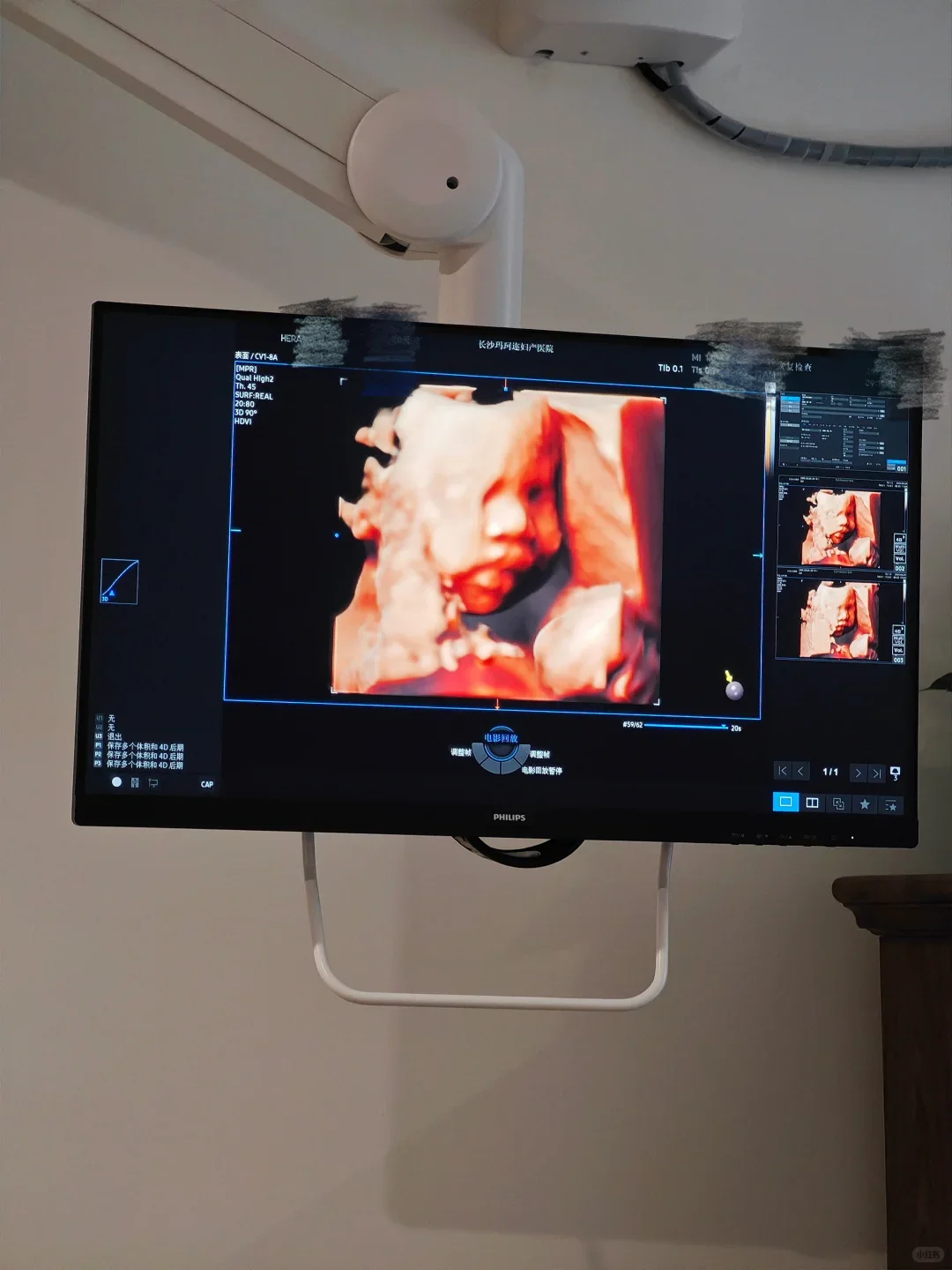 听劝！长沙准妈孕期检查一定要多试几个医院！