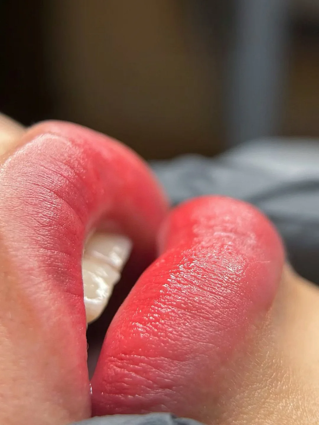 长治纹唇 | 修复唇部纹路 真的绝了
