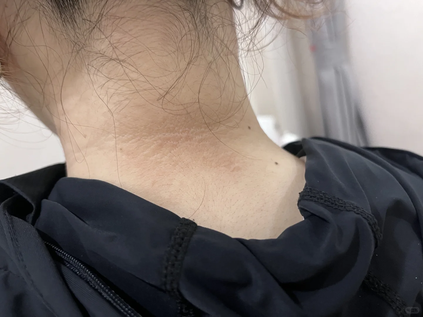 这是胰岛素抵抗好转的现象吗