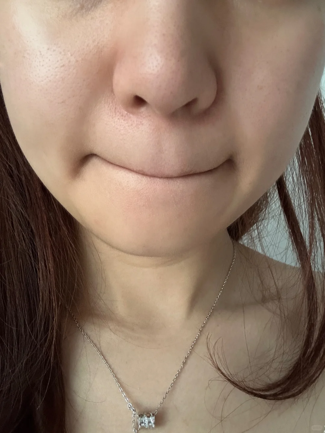 脂溢性皮炎稳定第二周