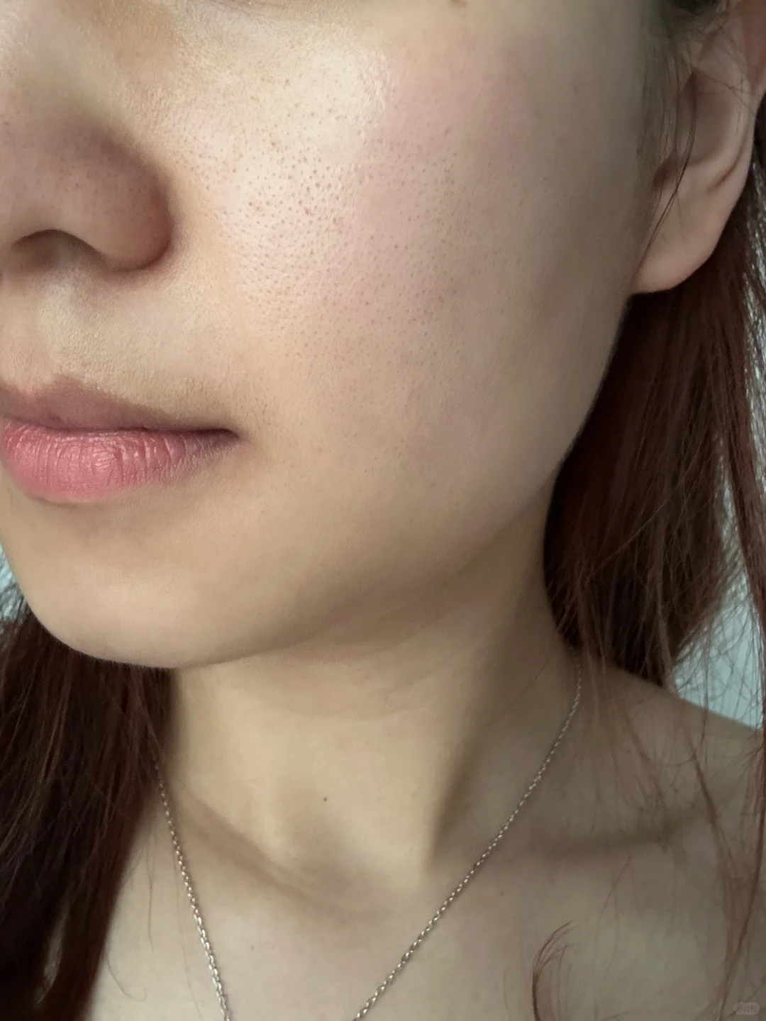 脂溢性皮炎稳定第二周