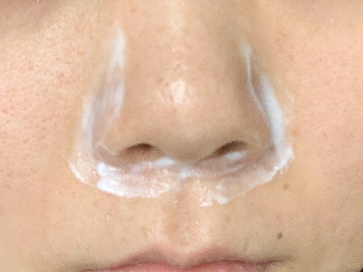 鼻周红红-脂溢性皮炎脸