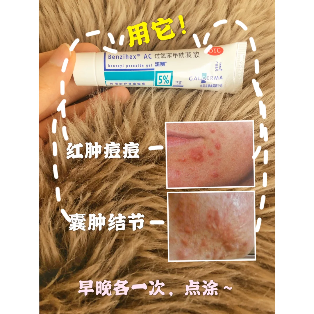 消灭痘痘就用三甲医院的这三支神仙药膏!