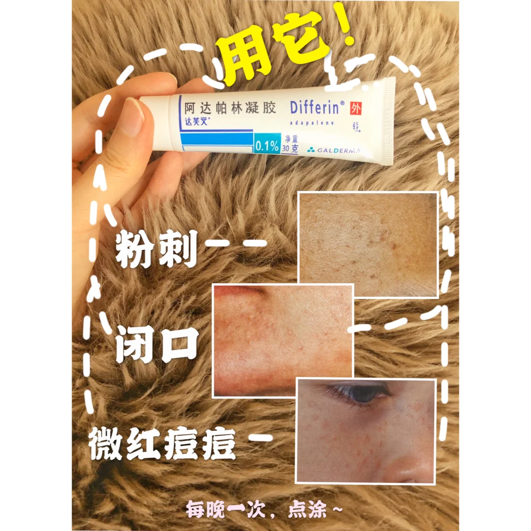 消灭痘痘就用三甲医院的这三支神仙药膏!