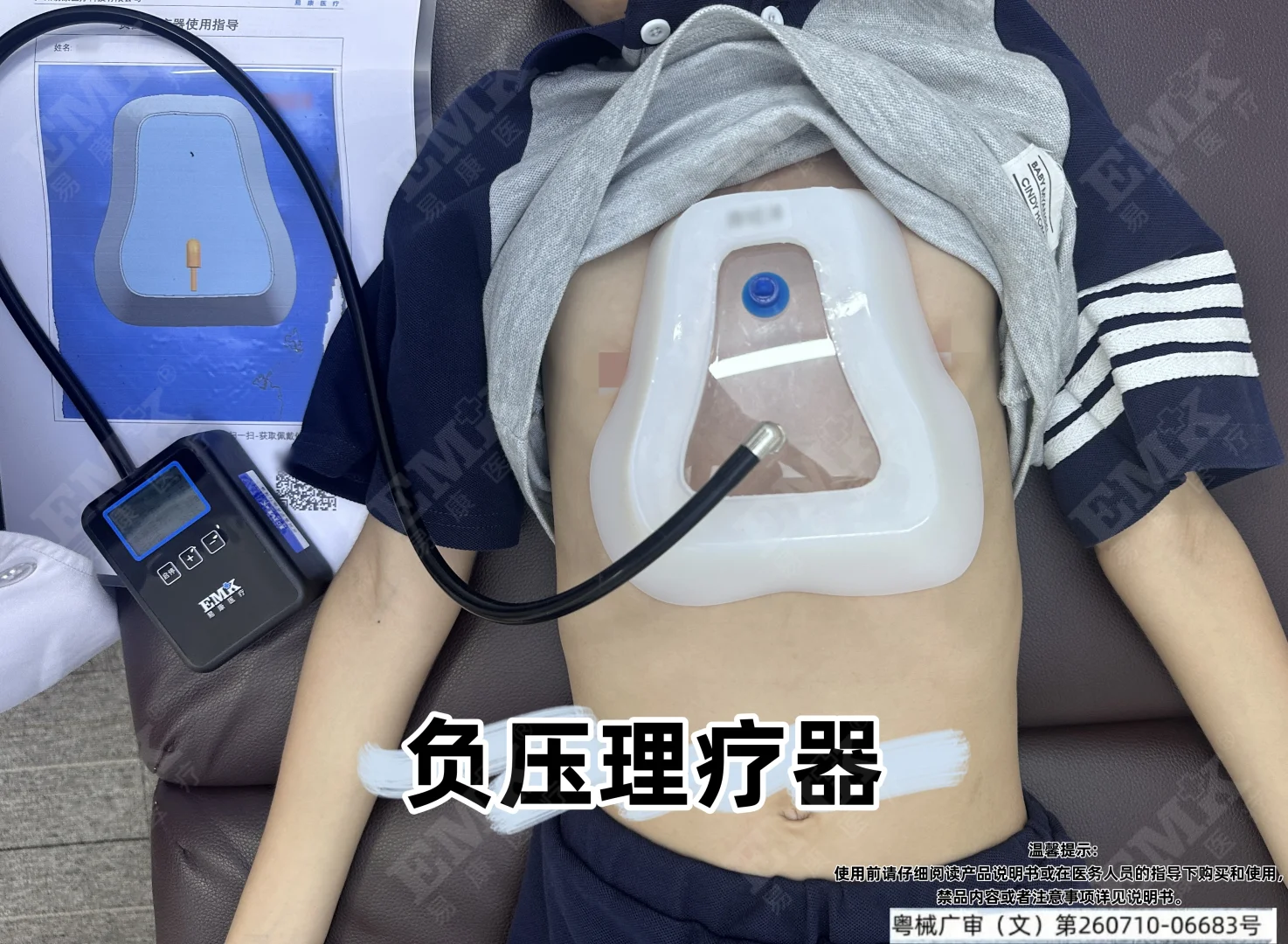 ? 易康医疗助力鸡胸漏斗胸矫形康复?