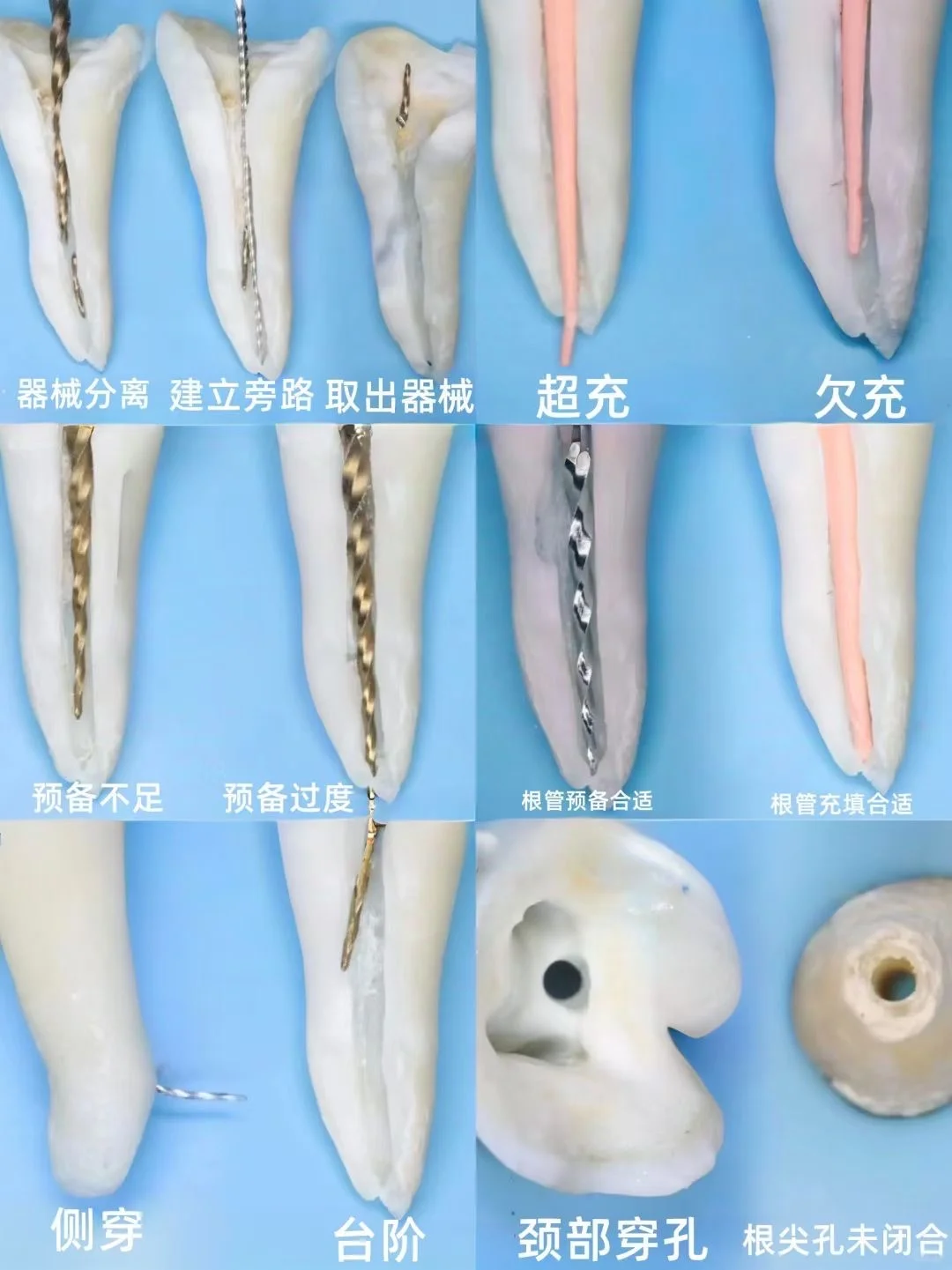 你知道根管主要是什么样的吗